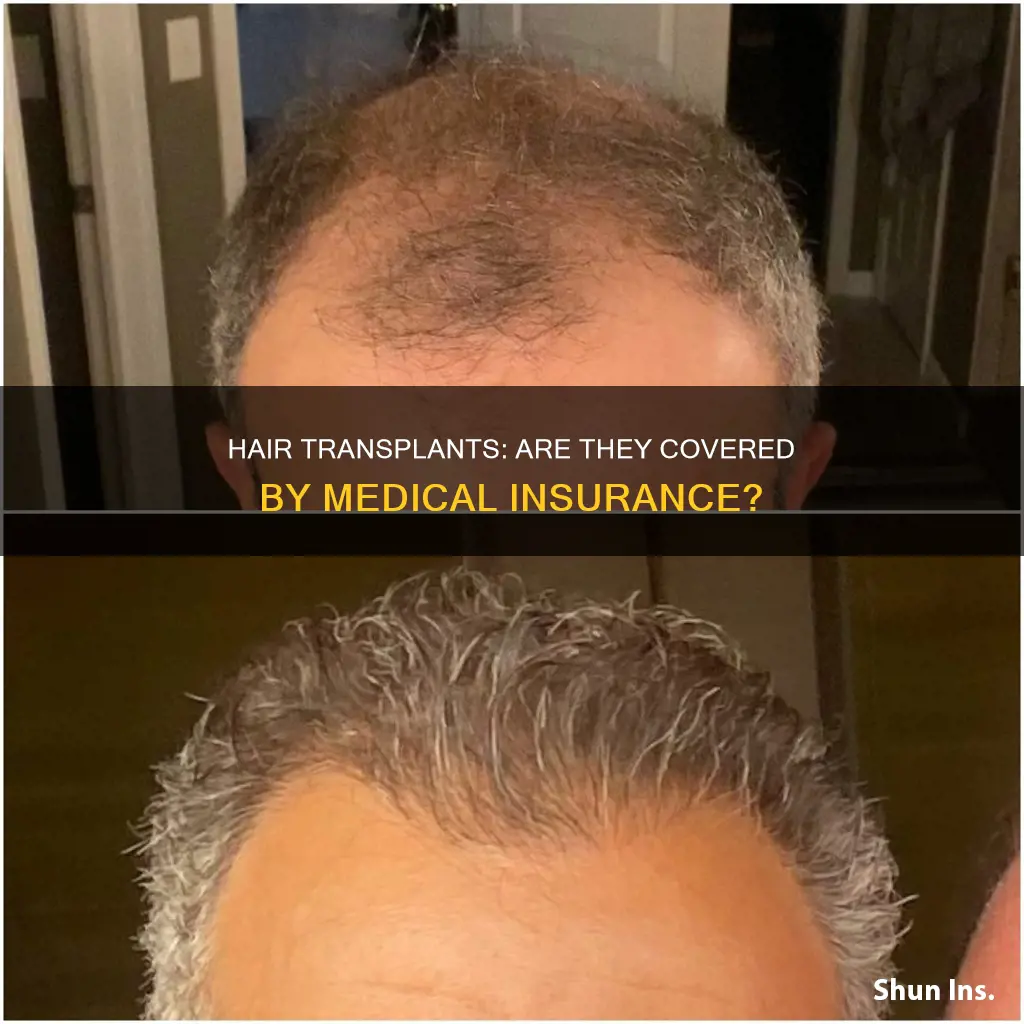 does medical insurance cover hair transplant