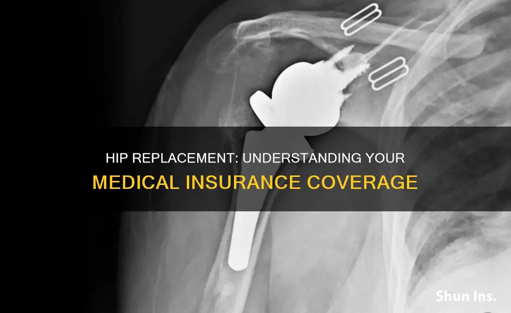 does medical insurance cover hip replacement