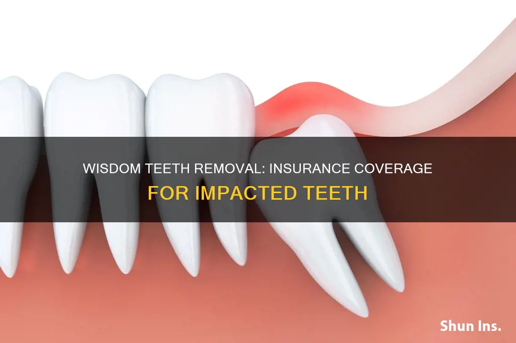 does medical insurance cover impacted wisdom teeth