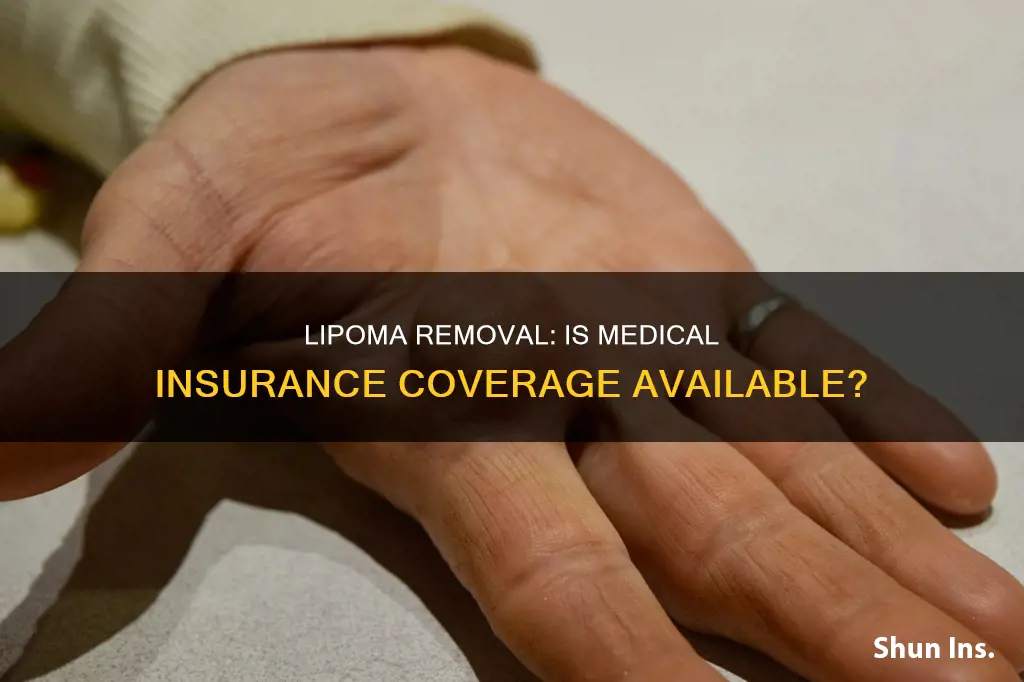 does medical insurance cover lipoma removal