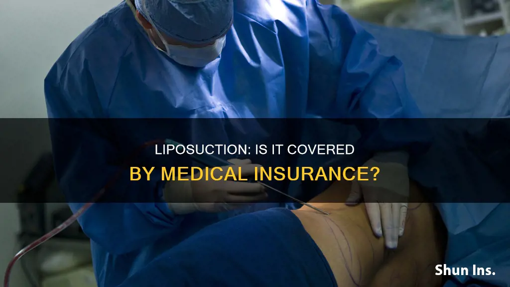 does medical insurance cover liposuction