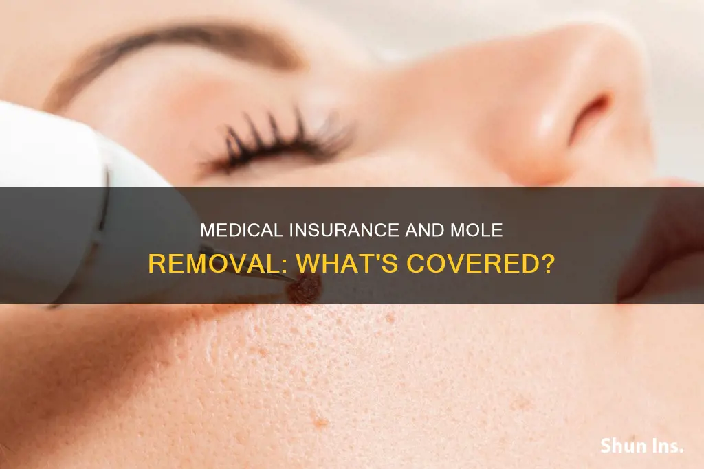 does medical insurance cover mole removal