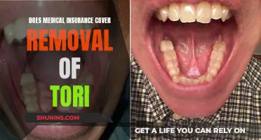 Medical Insurance and Tori Removal: What's Covered?