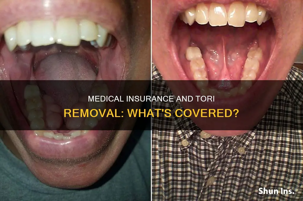 does medical insurance cover removal of tori