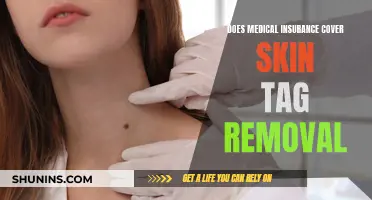 Skin Tag Removal: Is Medical Insurance Coverage Available?