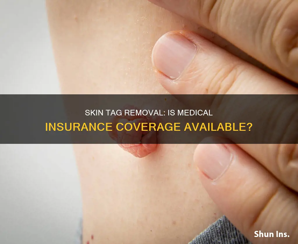 does medical insurance cover skin tag removal