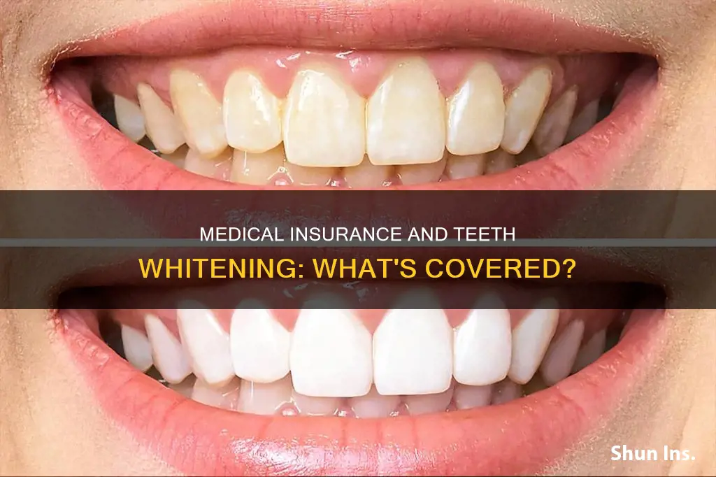 does medical insurance cover teeth whitening