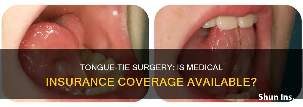 does medical insurance cover tongue tie surgery