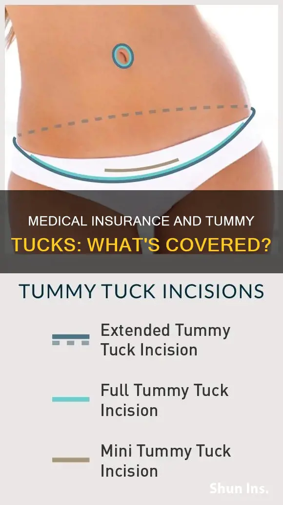 does medical insurance cover tummy tuck