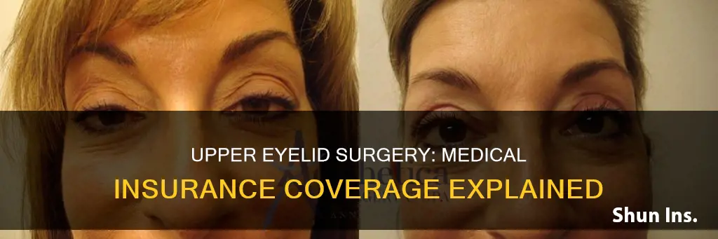 does medical insurance cover upper peye surgery
