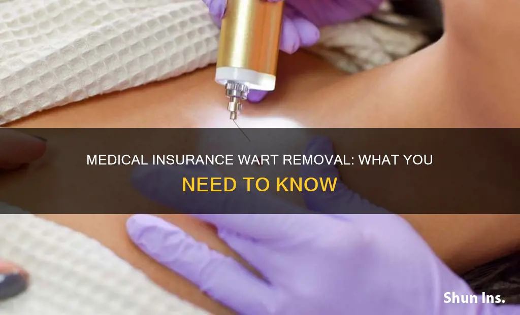 does medical insurance cover wart removal