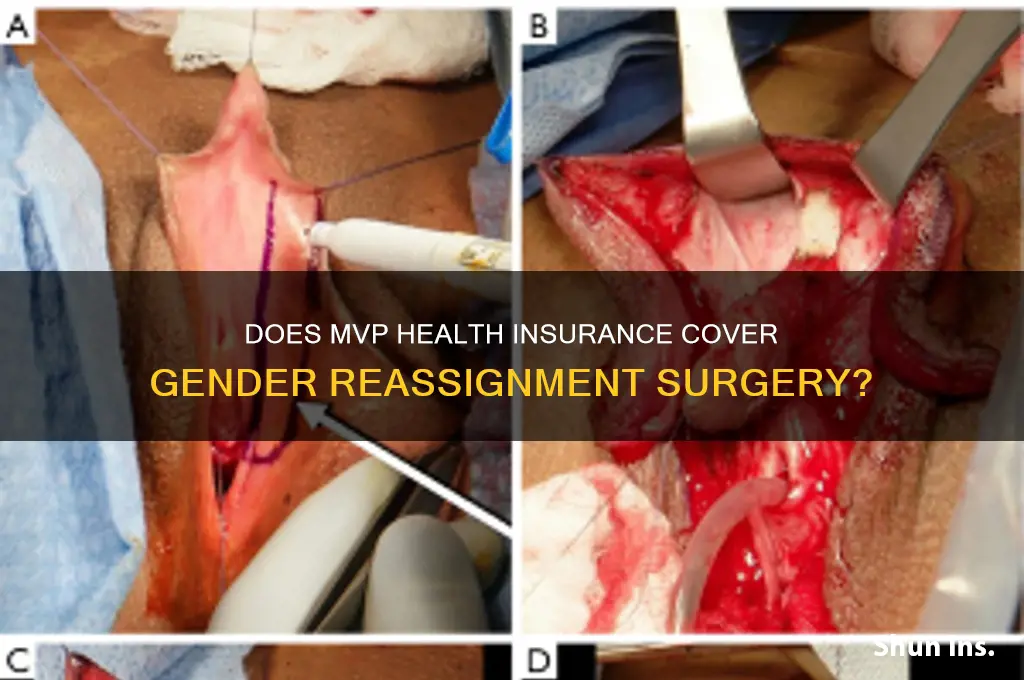 does mvp health insurance cover gender reassignment surgery