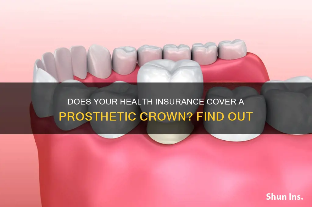 does my health insurance cover aprosthetic crown