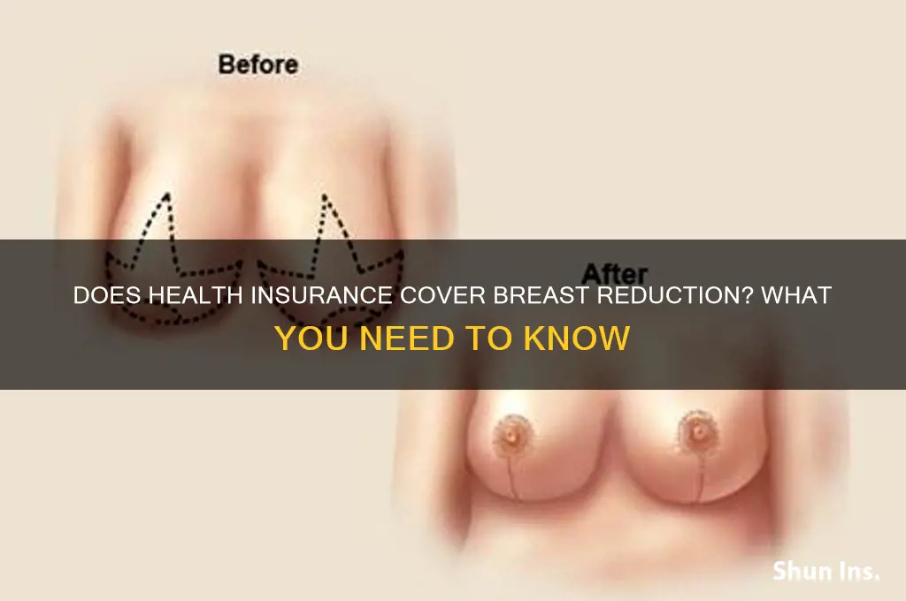 does my health insurance cover breast reduction