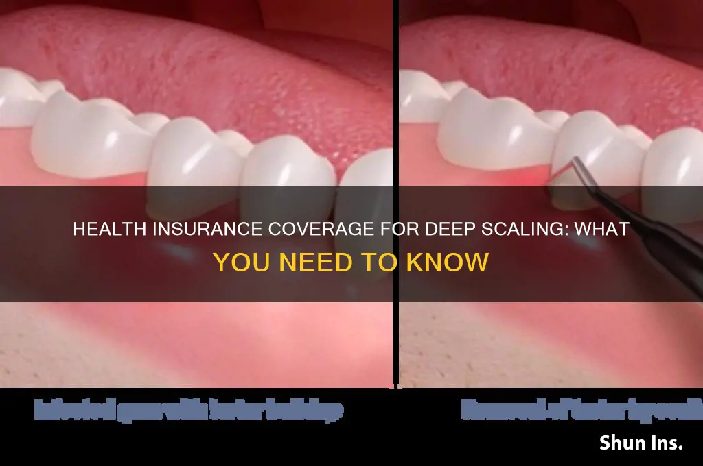does my health insurance cover deep scaling