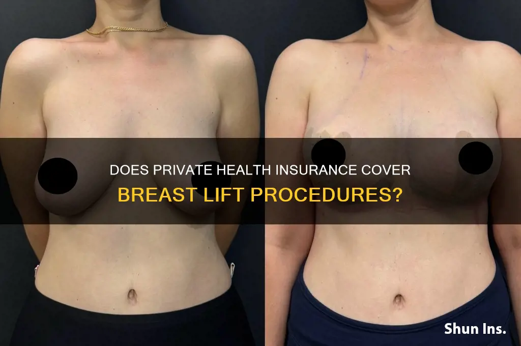 does private health insurance cover breast lift
