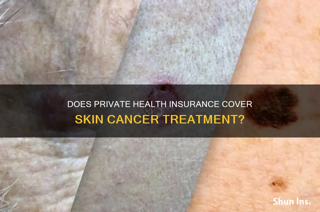 does private health insurance cover skin cancer