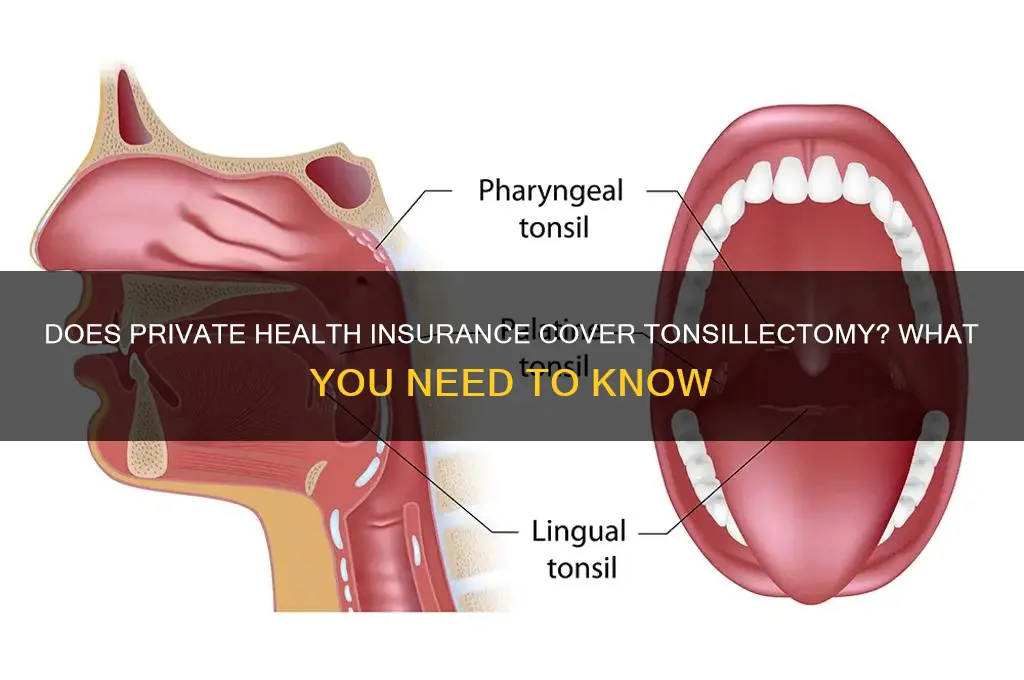 does private health insurance cover tonsillectomy