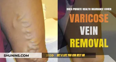 Does Private Health Insurance Cover Varicose Vein Removal?