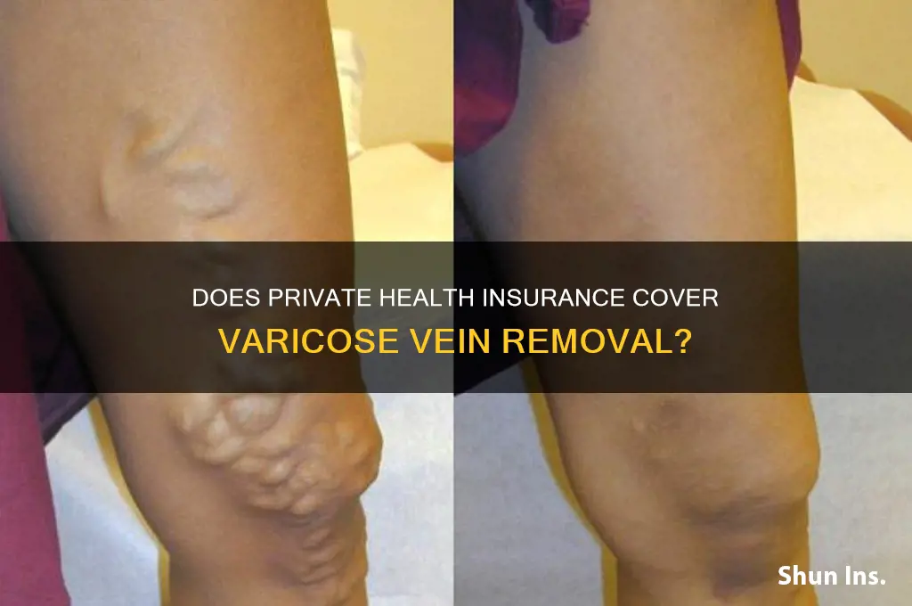 does private health insurance cover varicose vein removal