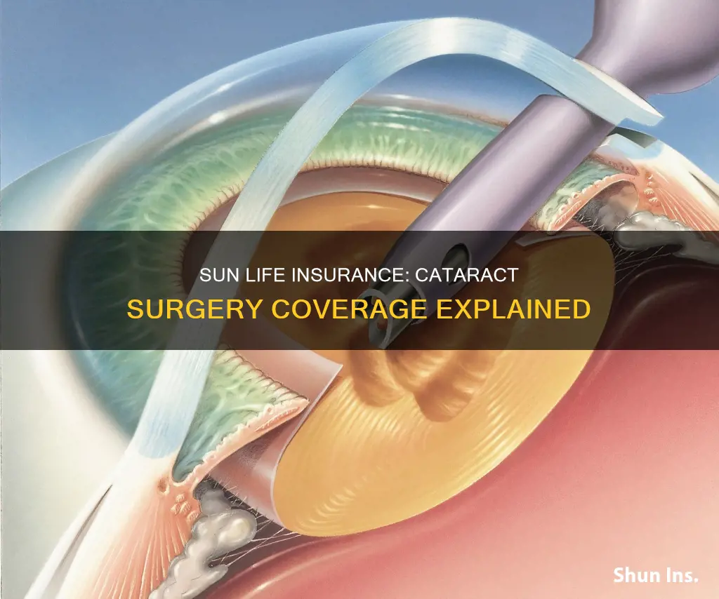 does sun life insurance cover cataract surgery