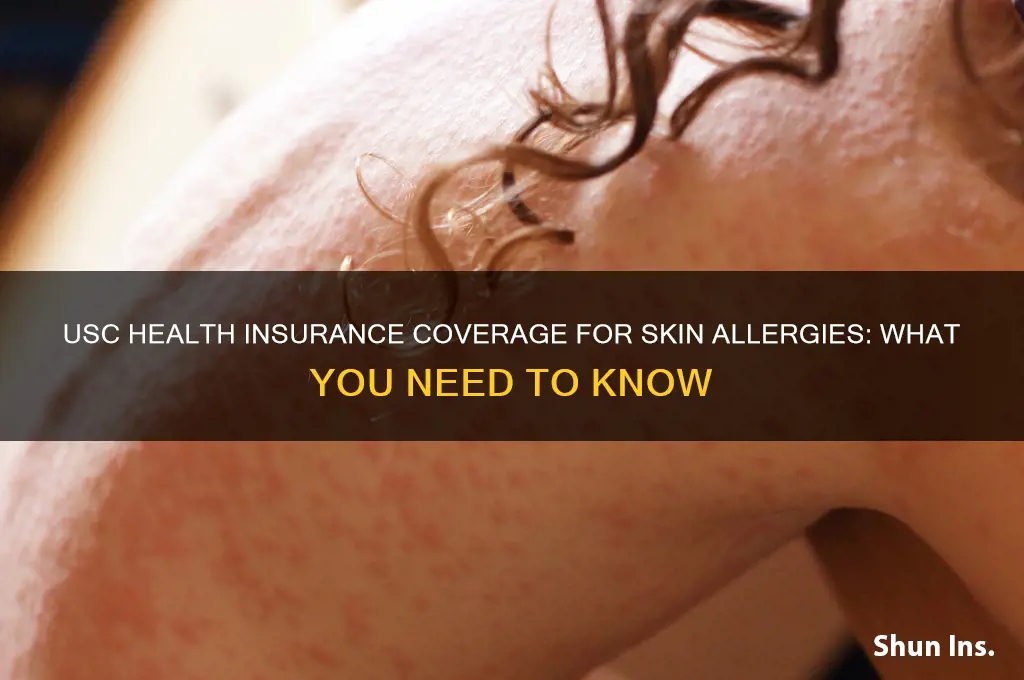does usc health insurance cover skin allergies