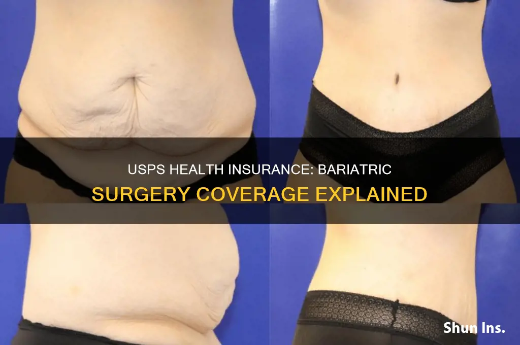 does usps health insurance cover bariatric surgery
