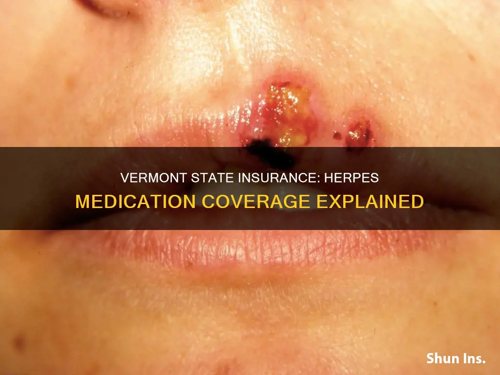 does vermont state insurance cover herpes medication