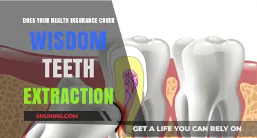 Wisdom Teeth Extraction: What Your Health Insurance May Cover