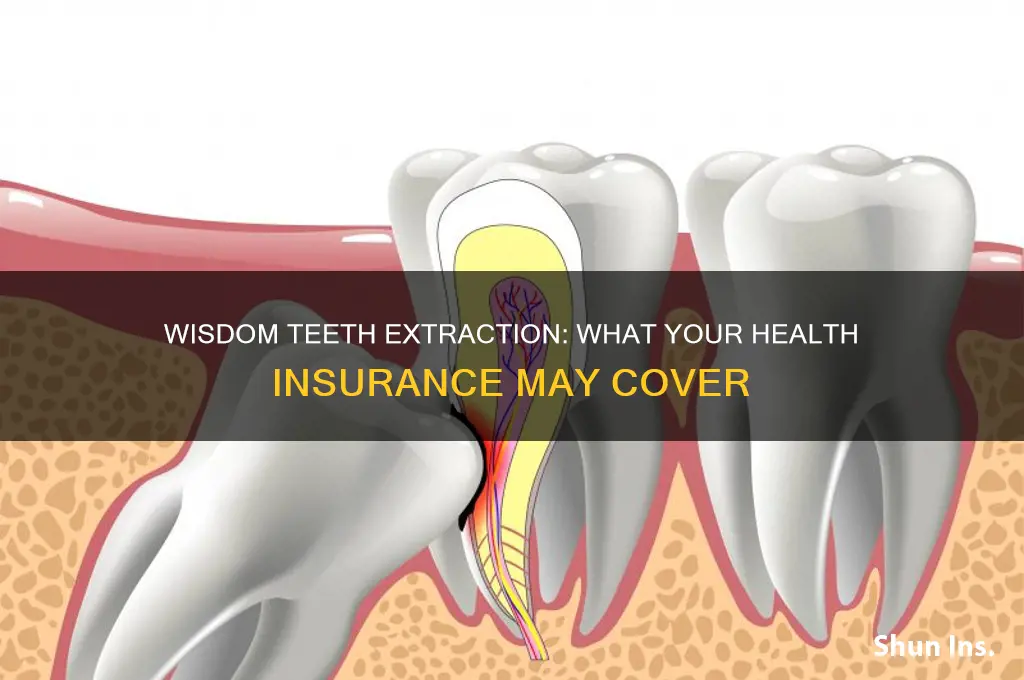 does your health insurance cover wisdom teeth extraction