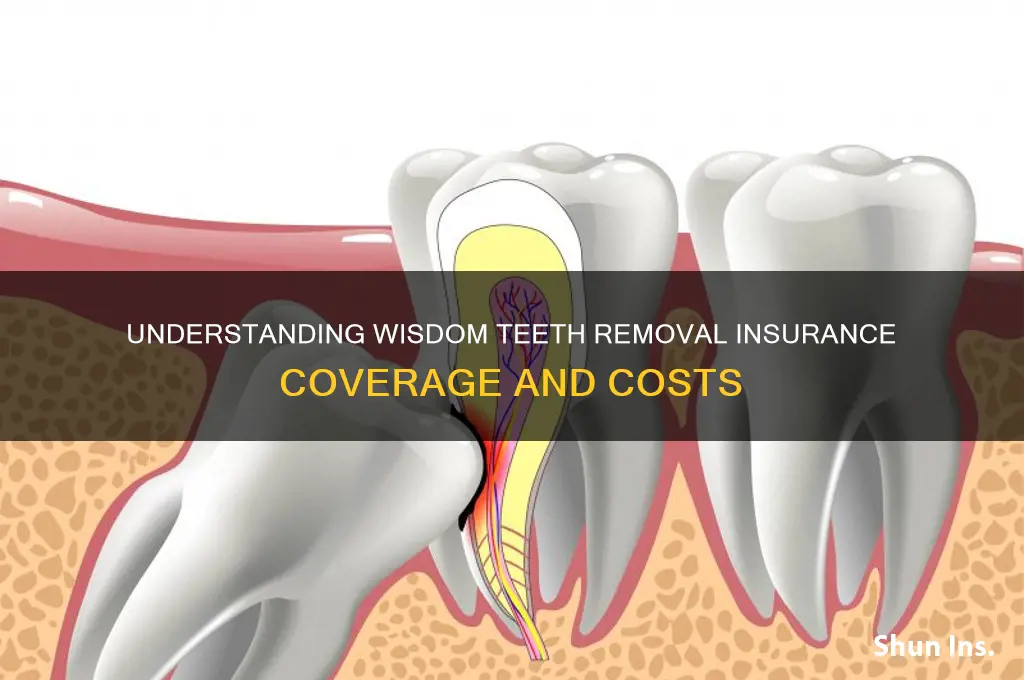 how does wisdom teeth removal insurance