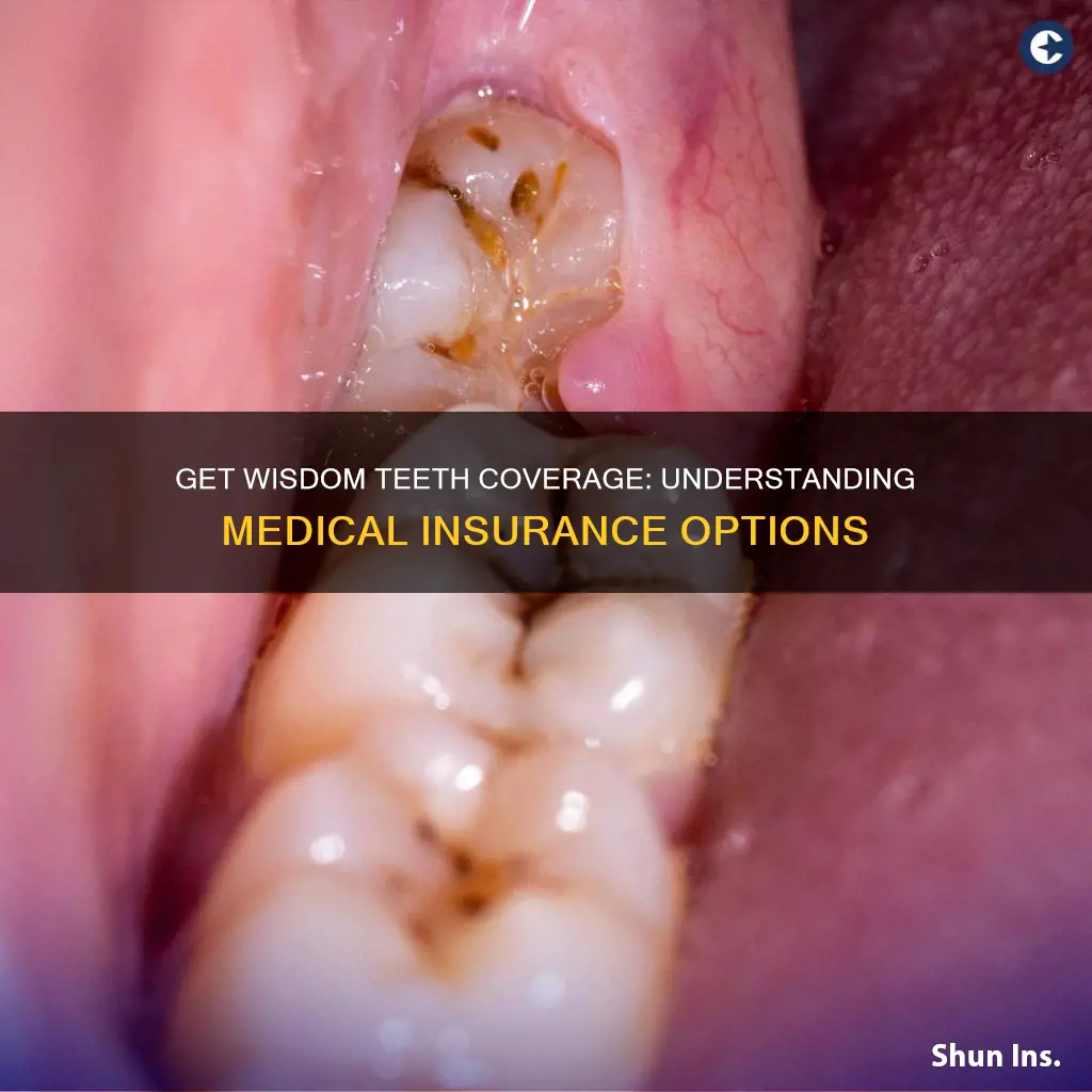 how to get medical insurance to cover wisdom teeth