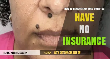 Affordable Skin Tag Removal Options for the Uninsured: A Guide