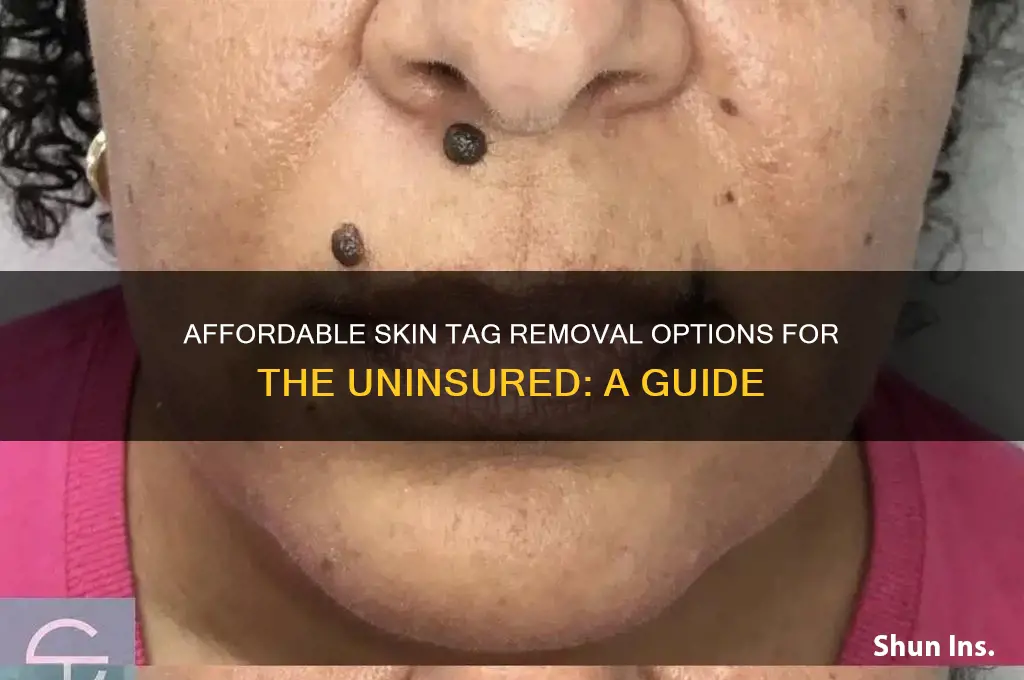how to remove skin tags when you have no insurance