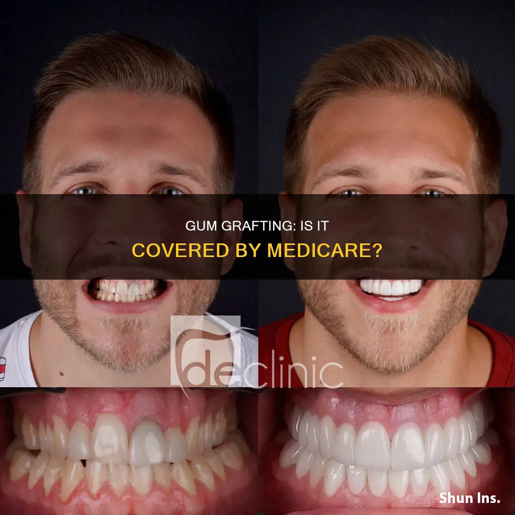 is gum grafting insured under medicare