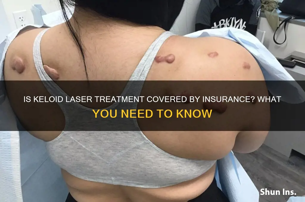 is keloid laser covred by insurance