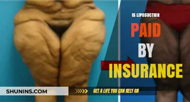 Does Insurance Cover Liposuction? Understanding Your Financial Options