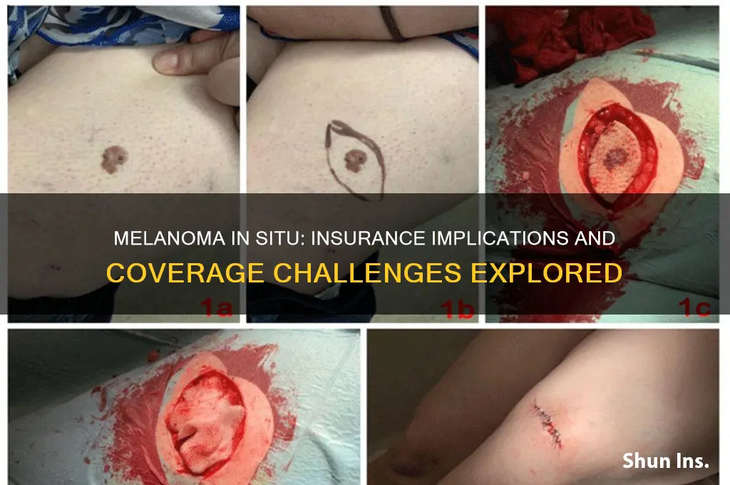 is melanoma in siru an insurance knockout