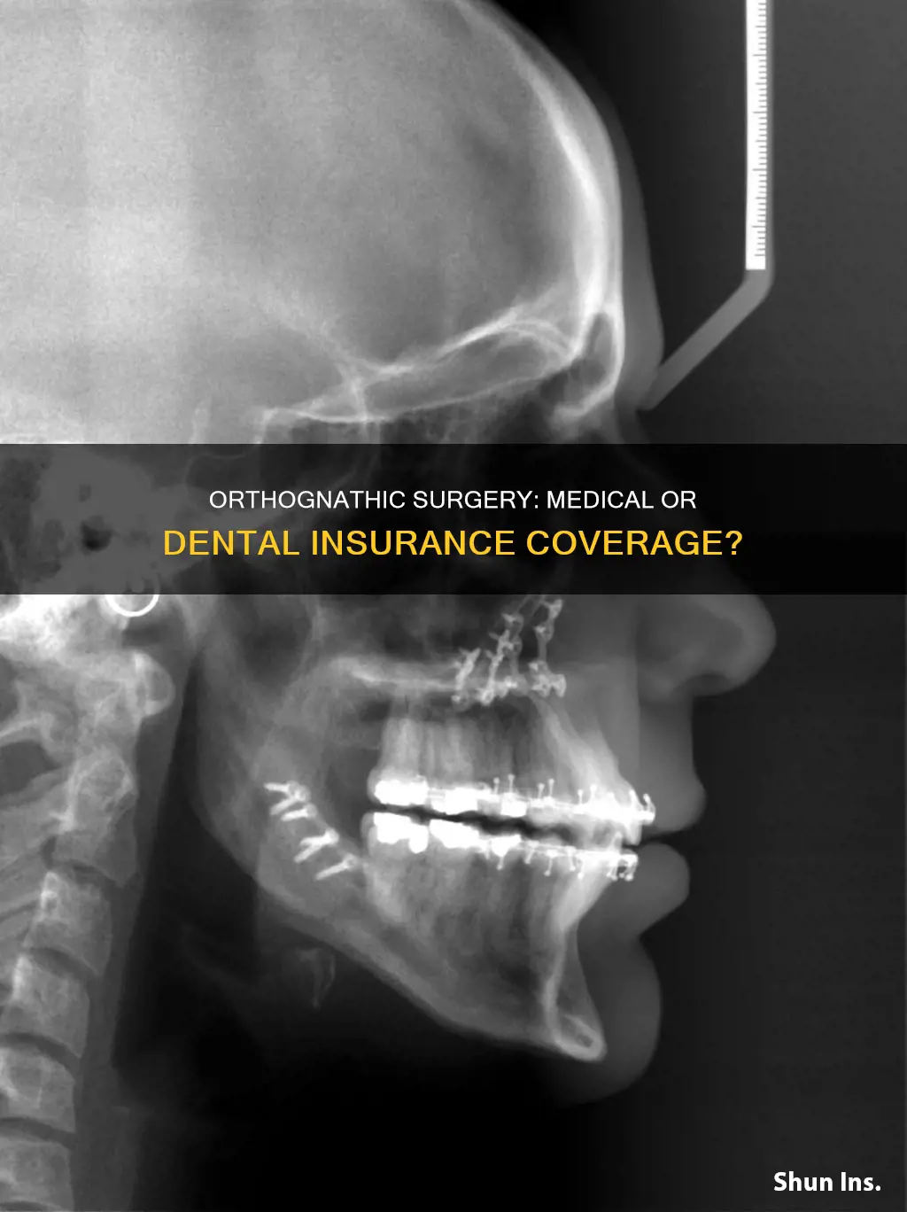is orthognathic surgery medical or dental insurance