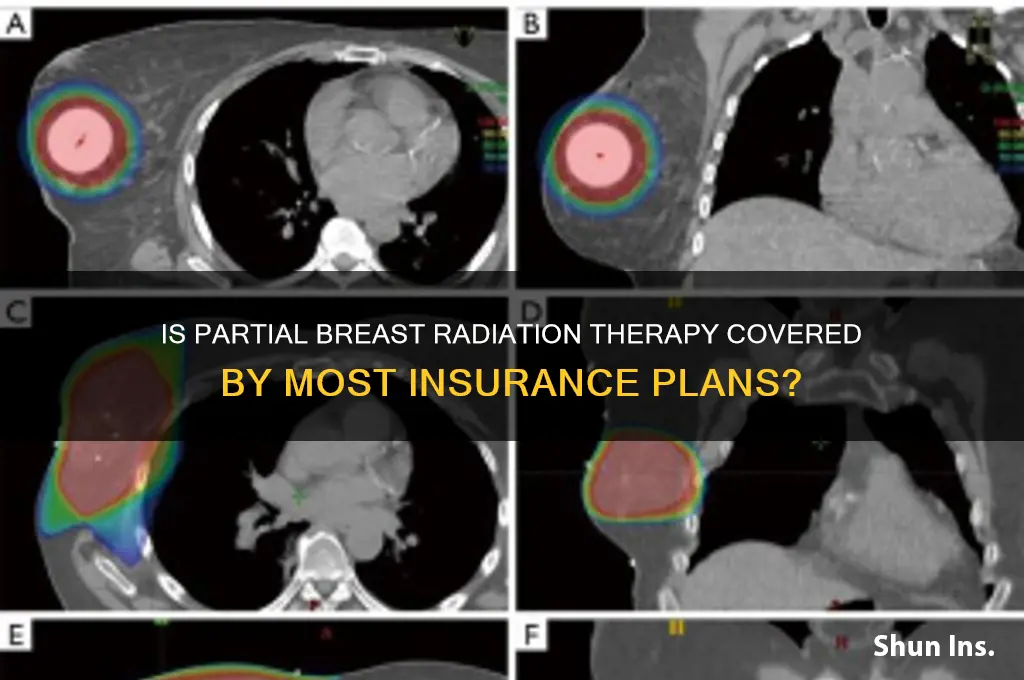 is partial breast radiation therapy excepted by most insureance