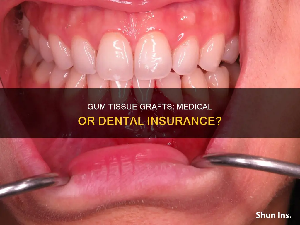 is periodontal gum tissue graft medical or dental insurance