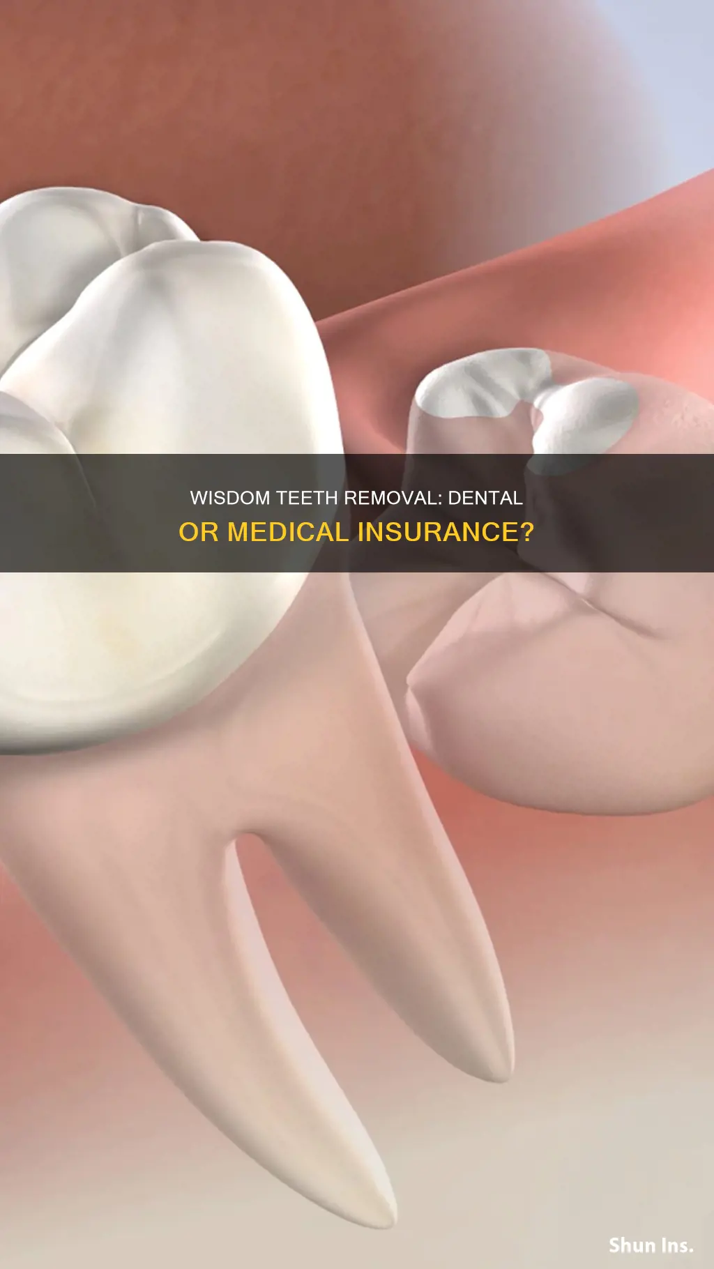 is wisdom teeth removal dental or medical insurance ambetter