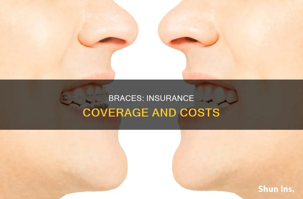 what are braces considered under insurance