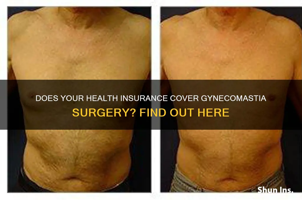 what health insurance cover gynecomastia surgery