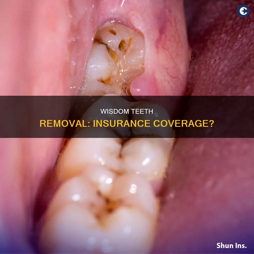 what is wisdom teeth removal considered for insurance