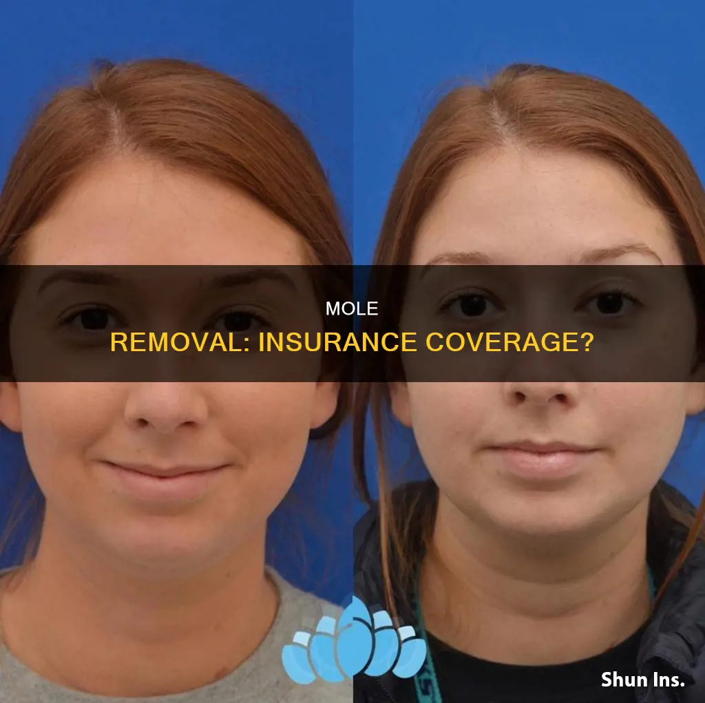 what procedure is mole removal considered by insurance