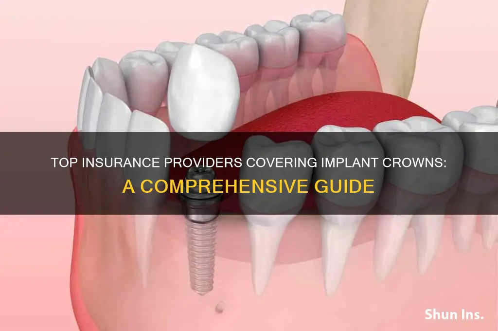 which insurance companies cover implant crowns