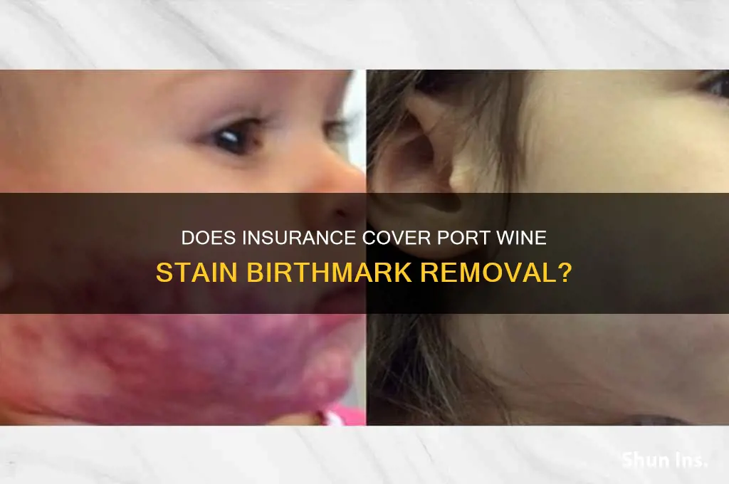 will insurance companies cover removal of port wine stain birthmarks